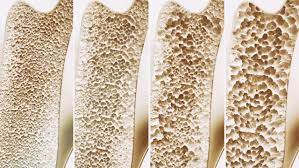 Entenda mais sobre Osteoporose